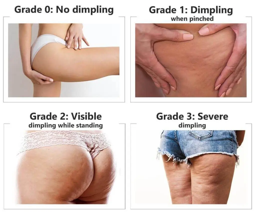 Representation of the stages of cellulite development Warminster Common